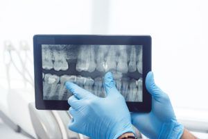myDentalTX.com - 9 Benefits of Digital Dental X-Rays