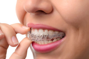 myDentalTX.com - Are You a Good Candidate for Invisalign