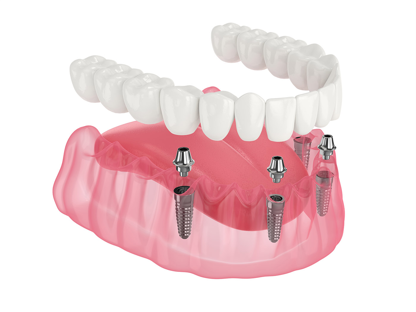 Comparing traditional dental implants with All-on-4 treatment