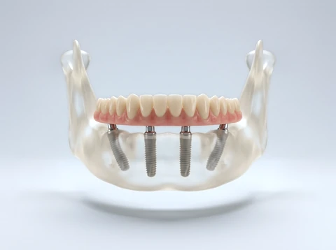 3D model of a lower jaw with four implants, the two back ones tilted, holding a fixed full-arch bridge