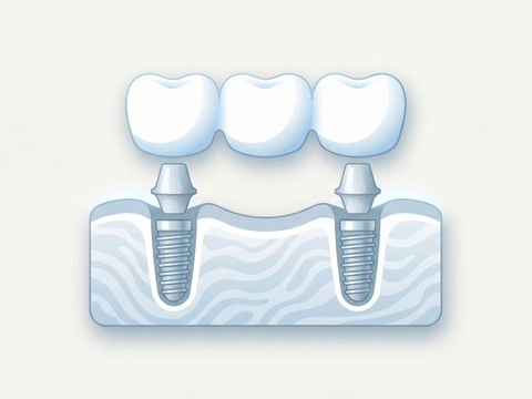 Implant-supported bridge replacing multiple missing teeth