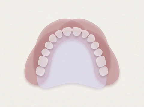 Full dentures illustration showing complete upper and lower tooth replacement